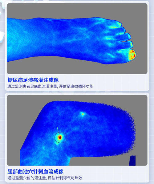 千亿国际激光散斑血流成像系统获批FDA认证